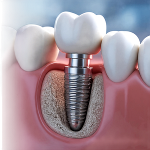 Implant Gigi Sakit Tidak? Ini yang Perlu Anda Tahu